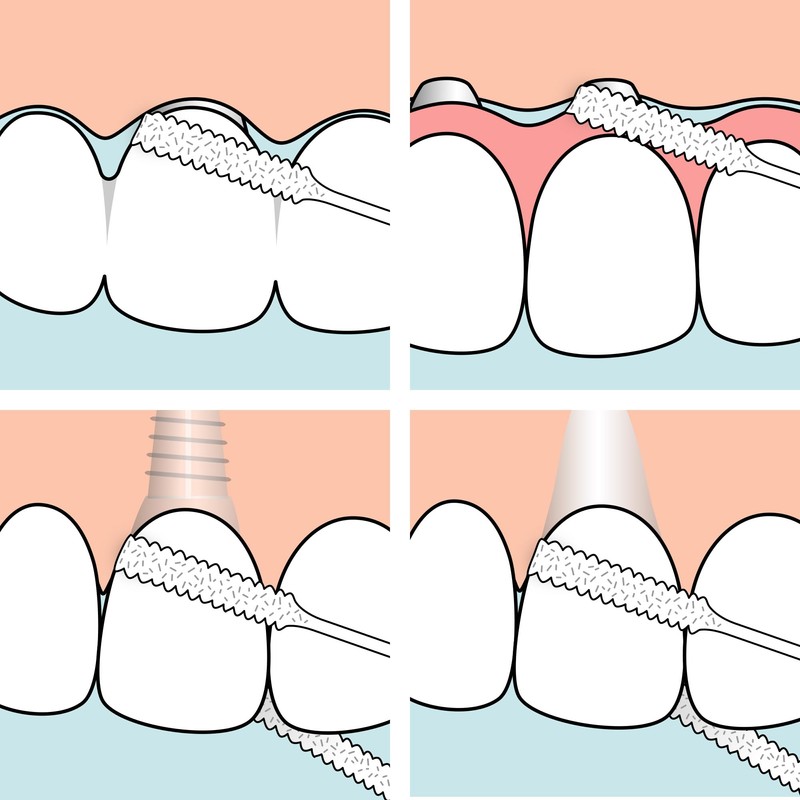 TePe Bridge und Implant Floss