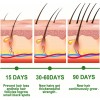 Pelo Aceite De Romero Para El Crecimiento Del Cabello, Suero