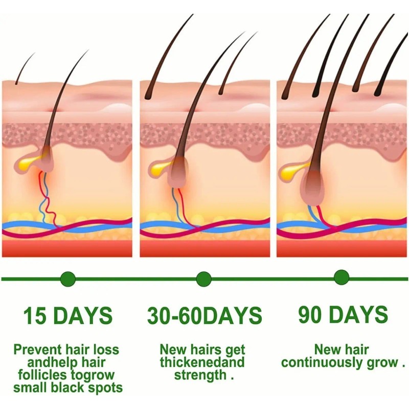Pelo Aceite De Romero Para El Crecimiento Del Cabello, Suero