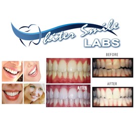 Professional Custom Teeth Whitening Tray Kit. Dental Lab Direct, Custom Made Teeth Whitening Tray, U.S.A Made Bleaching Trays with 38% High Intensity Gel Fast Results Custom Upper and Lower Trays