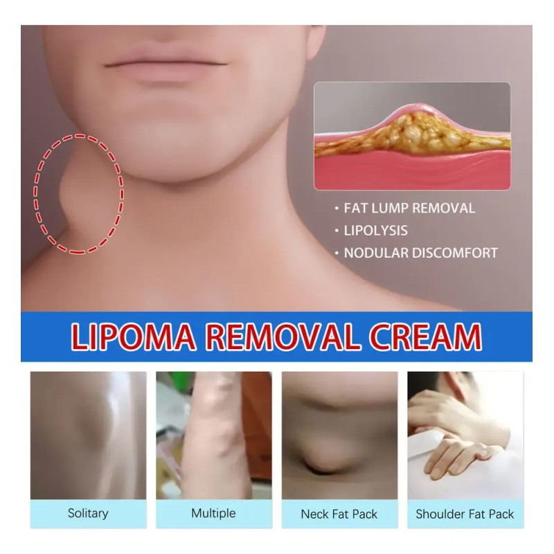 Jx Crema Limpiadora Para Lipomas Nc4c, Bloqueadora Grasa, 1