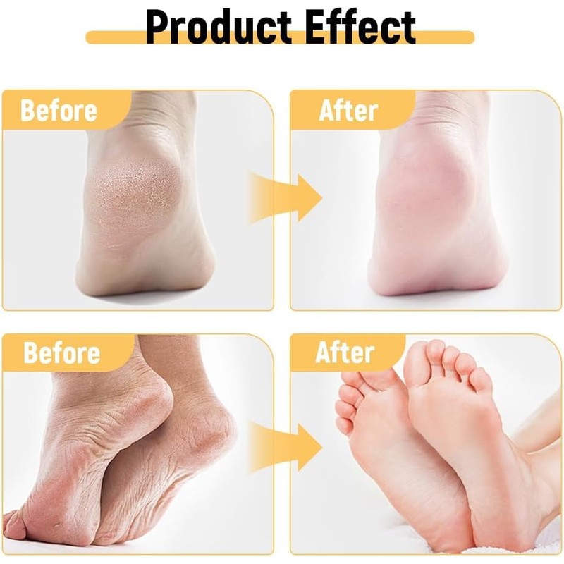 Anti-Cracking Cream, For Dry Cracked Feet And Hands, Prevent From