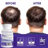 Propidren by HairGenics - DHT Blocker with Saw Palmetto To