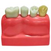 Windplusya Dental Implant Model 4 Times Implant Teeth Model, Analysis