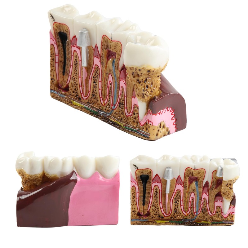 Dental Caries Tooth Anatomy Model Tooth Pathology Models Caries Evolution