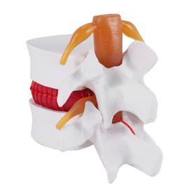 TOBEOME 1:1.5 Human Demonstration Model for Herniated Disc of the Lumbar Spine Model for Human Anatomy