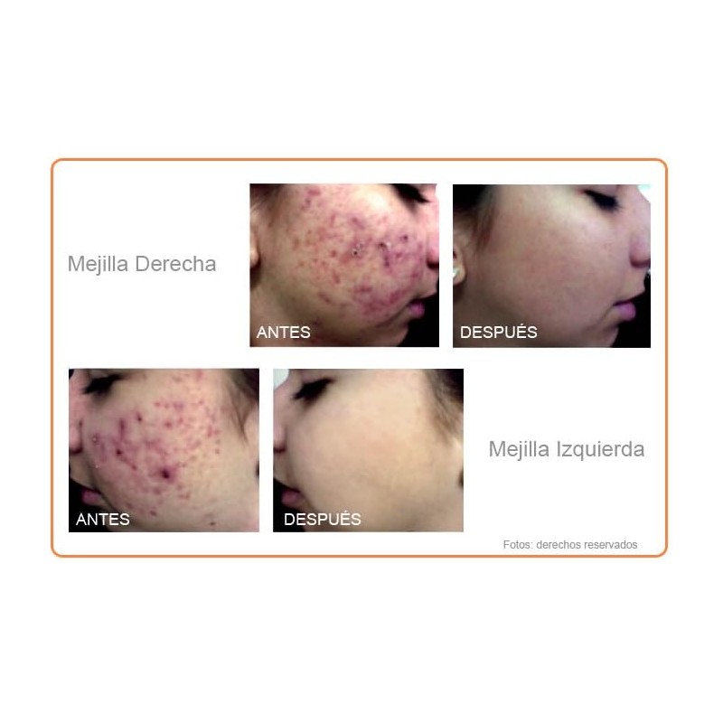 DCI SOLUCION ANTIACNE
