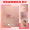 Loción Secante Antiacné Ácido Salicílico 10ml Oukeya