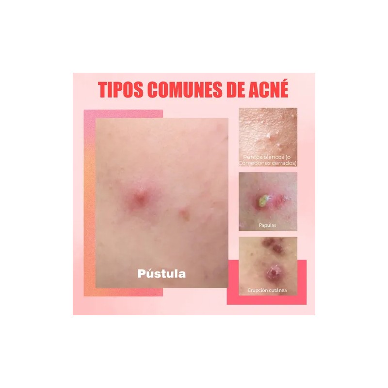 Loción Secante Antiacné Ácido Salicílico 10ml Oukeya