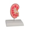 Kidney stone model