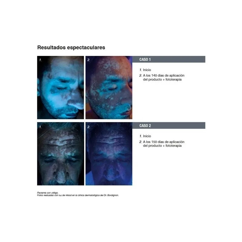 Repigment12 Tratamiento Para Pieles Con Hipopigmentacion Momento de aplicación Día/Noche