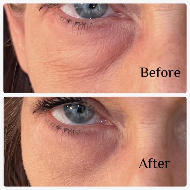 Instant Eye Bag Puffiness And Wrinkle Remover Cream For Women