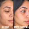 Niacinamide 10% +Zink 1% +Hyaluronic Acid | Acne/Blemish/Oil Control Serum/Cream
