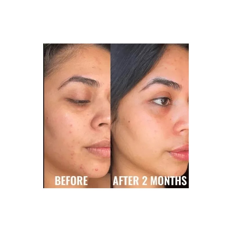 Niacinamide 10% +Zink 1% +Hyaluronic Acid | Acne/Blemish/Oil Control Serum/Cream