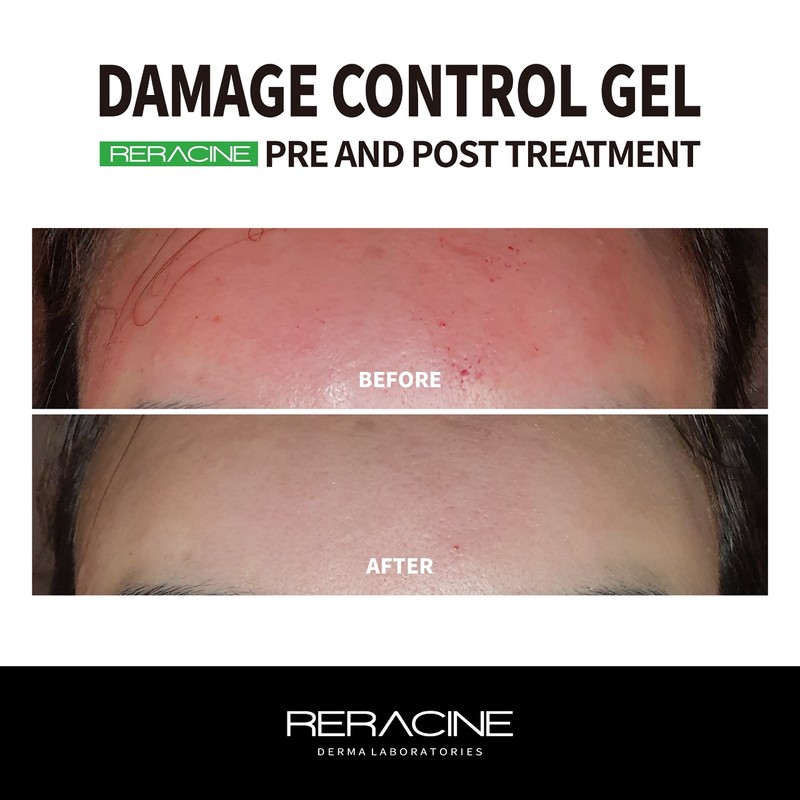Lyricin [Newly launched] Lyracin gel damage control gel pouches 5mlx20