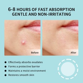 GOESTRIC Pimple Patches for Face - Hydrocolloid Acne Patches,Invisible Zit Stickers for Covering Blemishes,3 Sizes (72 Count)