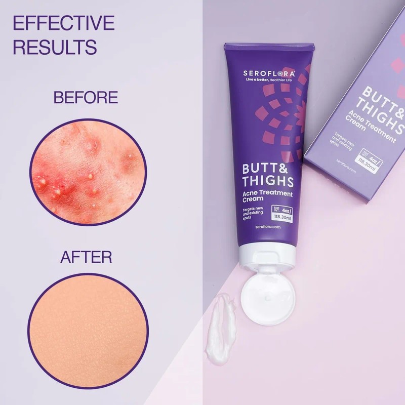 Crema De Tratamiento Para El Acné De Glúteos Y Muslos,