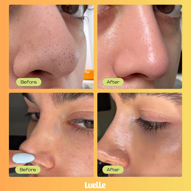 Pore Strips, Deep Cleansing Patch System, Blackhead Remover, Nose Plants