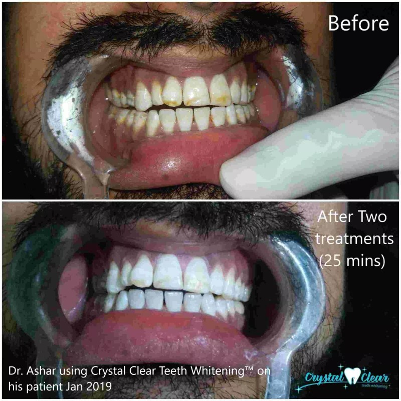Crystal Clear Kit Blanqueamiento Dental Profesional DDS. Recargable