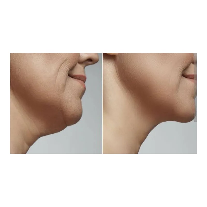 Crema Para Reducir Papada Tonificar Cuello Adelgaza Reafirma Fresh