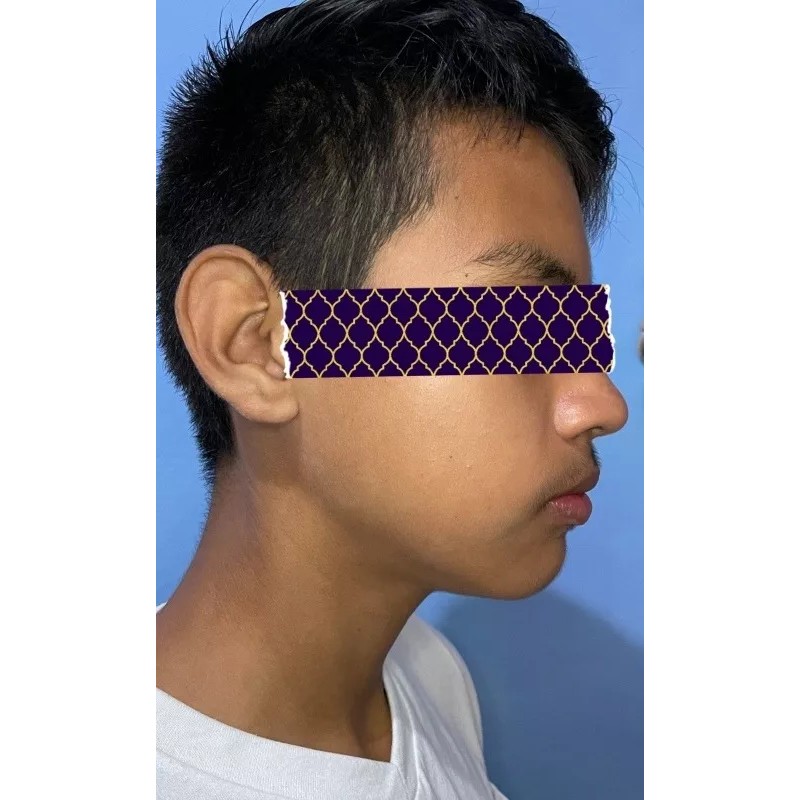 Trainer 3 Fases Dentales Bruxismo Tratamiento Completo