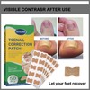 50 pieces toenail patch, toenail correction patch, corrector pedicure tools,