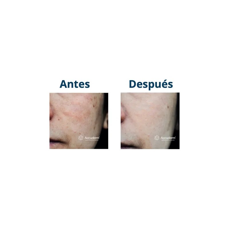 Accuderm Suero Despigmentante Regulador 30ml Unifica El Tono
