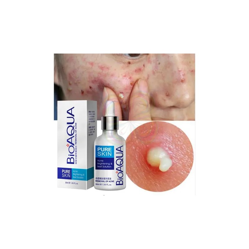 Serum Facial Pure Skin Retira Acné Y Espinillas 2pz Full