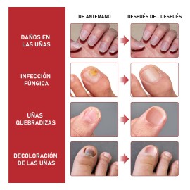 Fungicida Para Uñas Eliminar Hongos En Uñas De Manos Y Pies