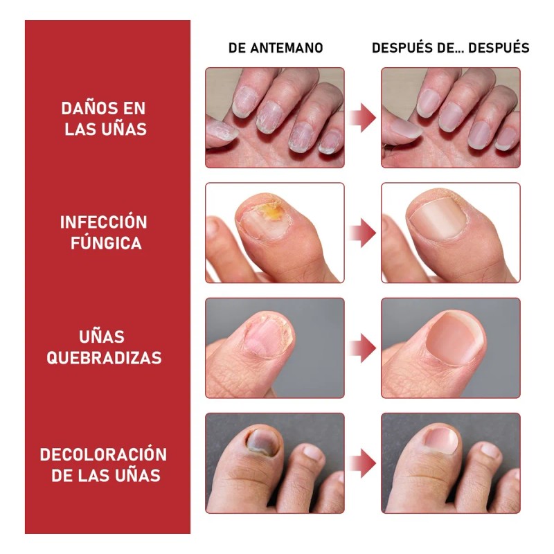 Fungicida Para Uñas Eliminar Hongos En Uñas De Manos Y