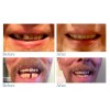 Instant Smile Temporary Tooth Kit - Pro-Series