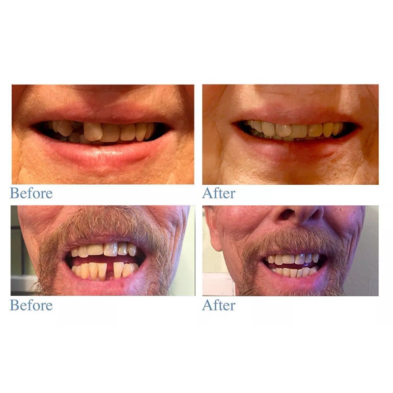 Instant Smile Temporary Tooth Kit - Pro-Series