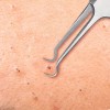 Margalla Int® Sharp Tweezers Blackhead Pimple Popper Remover Professional Skin