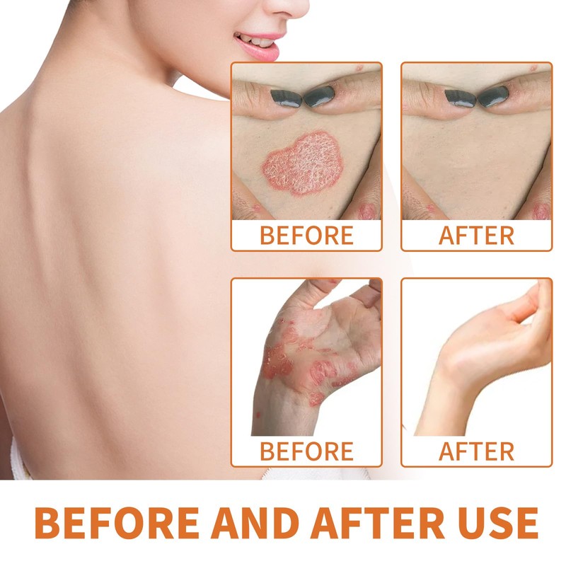 20g Skin Care Cream, Can Relieve Redness, Itching, Relieve and