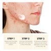 Tamoskiny Acne Face Blemish Pimple Cream Salicylic Cystic Breakout Treatment