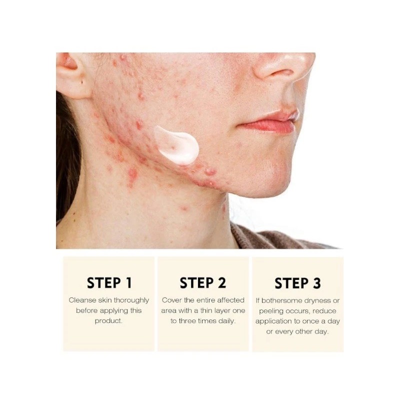 Tamoskiny Acne Face Blemish Pimple Cream Salicylic Cystic Breakout Treatment