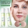 Salicylsäure Anti-Pickel Reparatur Toner Und Reparatur Lotion Set, Tiefenreinigung Der