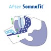 SomniShop Set, SomnoFit Premium Anti Snoring Splint with Additional Set