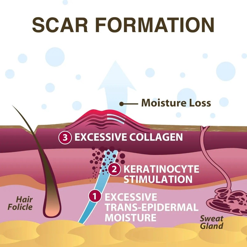 Scar Aid (pro-sil) Gel Silicón En Lápiz Para Cicatrices
