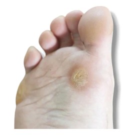 Liquido Mararavilla Hongos-mezquinos-verrugas 3 Frascos