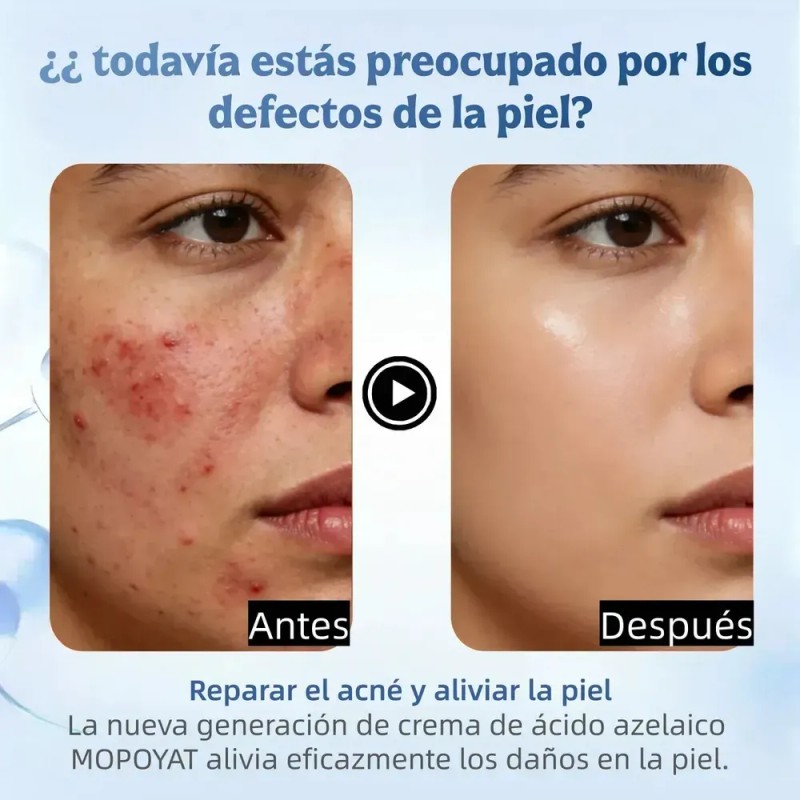 Ácido Azelaico Crema Con 20% Vitamina C Y Niacinamida Todo