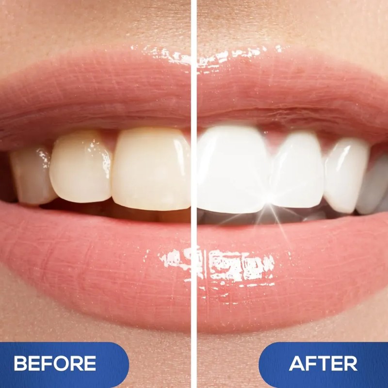 Lápiz Blanqueador Dental Venus Visage, Galardonado, Con Más