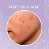 Crema Despigmentante Manchas Melasma Acné Paño