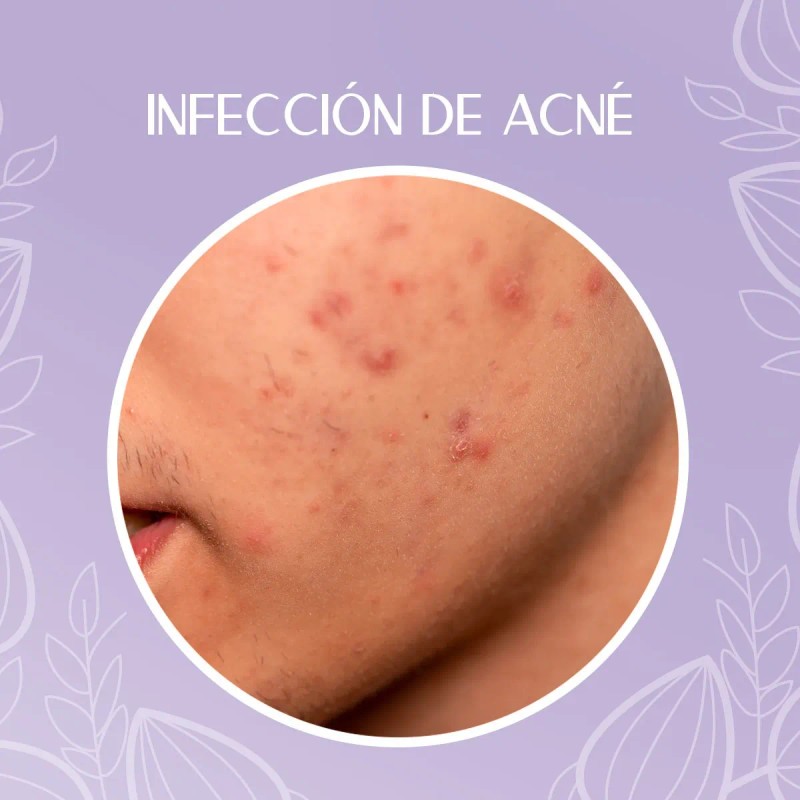 Crema Despigmentante Manchas Melasma Acné Paño