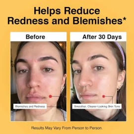 Foundation Skincare Ácido Azelaico Para La Cara 14% (1 Onza
