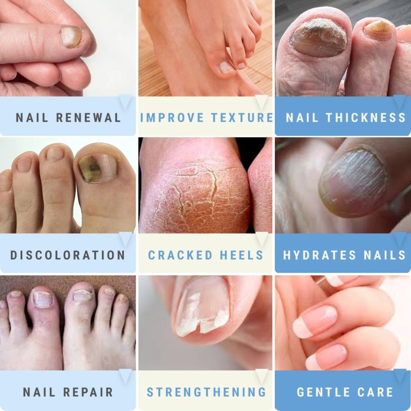 Scientific Solutions Global 50% Urea Nail Gel - Softens Cracked