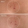 Murad Acne Body Duo Savings Bundle – Exfoliating Cleanser &
