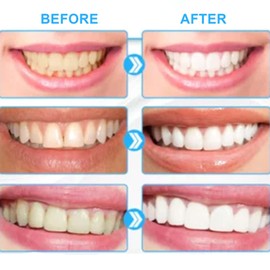 Bleaching Teeth Set- Professional Teeth Whitening Kit for Home Use, 6 Whitening Gels & 2 Desensitizing Gels, Safe for All Teeth Types, Easy to Use for Smokers/Coffee Lovers