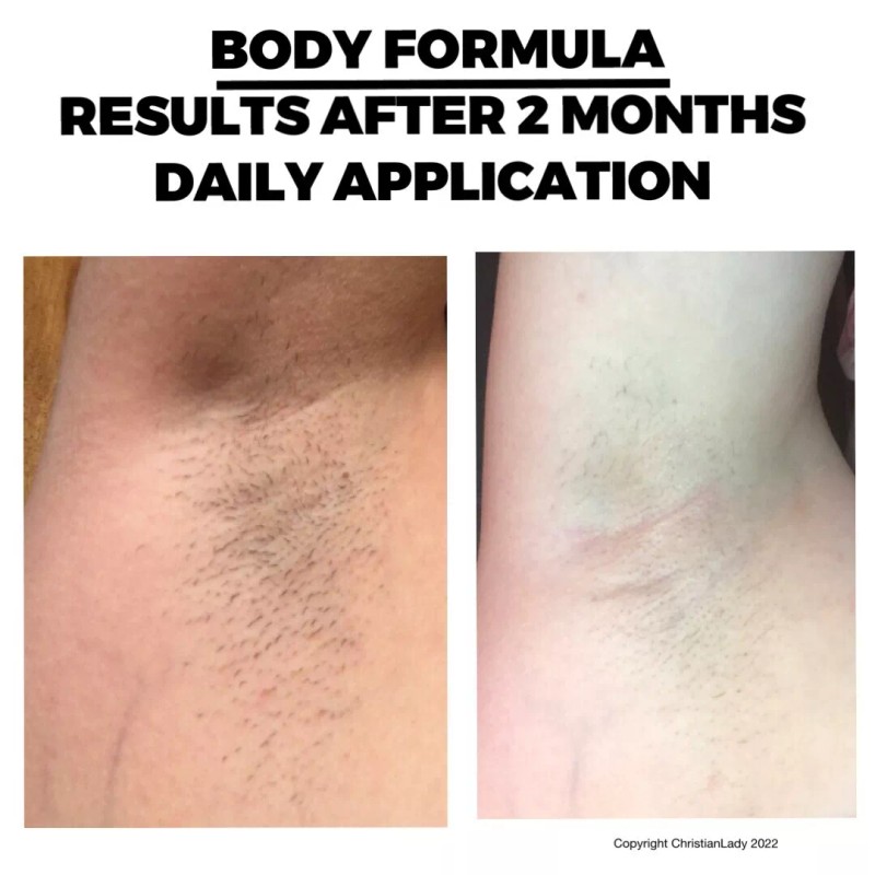 Electrologists Formula Permanent Hair Reduction At Home-Professio