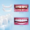 Temporary Veneers Kit for Women and Men, Tooth Replacement Kit,